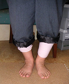 変形性膝関節症の膝